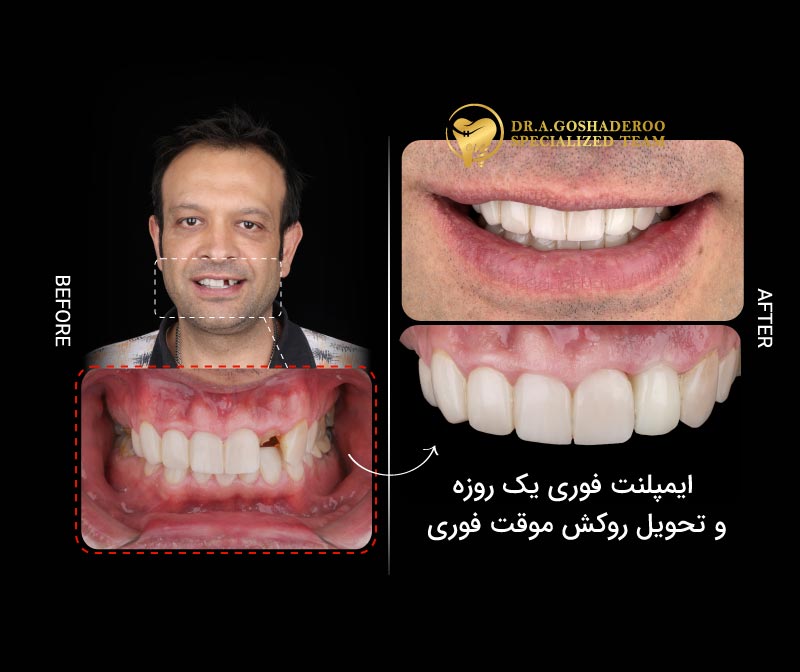 ایمپلنت فوری یک روزه و تحویل روکش موقت فوری
